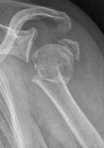 Proximaler Oberarmbruch9